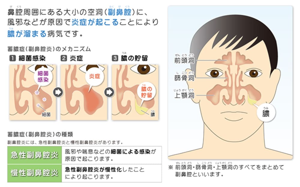 副鼻腔炎症候群の症状